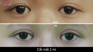 cat-mat-2-mi-co-anh-huong-den-thi-luc-cua-mat-khong-1