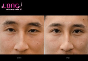 bam-mat-2-mi-han-quoc-cach-lam-mat-1-mi-thanh-2-mi-khong-phau-thuat-1