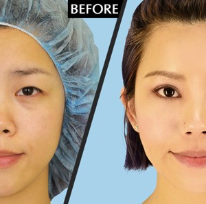 Bấm mí mắt không phẫu thuật giữ được bao lâu ?
