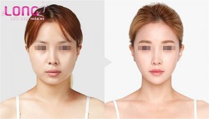phuong-phap-don-cam-vline-cho-nguoi-mat-tron