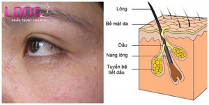 toi-nguyen-lieu-dieu-tri-mun-thit-than-ky-1