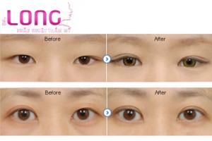 cach-cham-soc-khong-de-lai-seo-xau-sau-cat-mat-2-mi-1