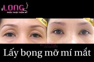 lay-bong-mo-mat-co-xoa-duoc-bong-mo-mi-duoi-khong-1