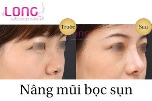 phau-thuat-nang-mui-boc-sun-co-dau-khong-2