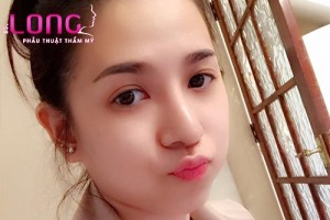 bam-mat-2-mi-xong-cham-soc-nhu-the-nao