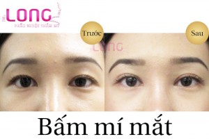 nguoi-bi-mat-xech-co-bam-mi-mat-duoc-khong-1