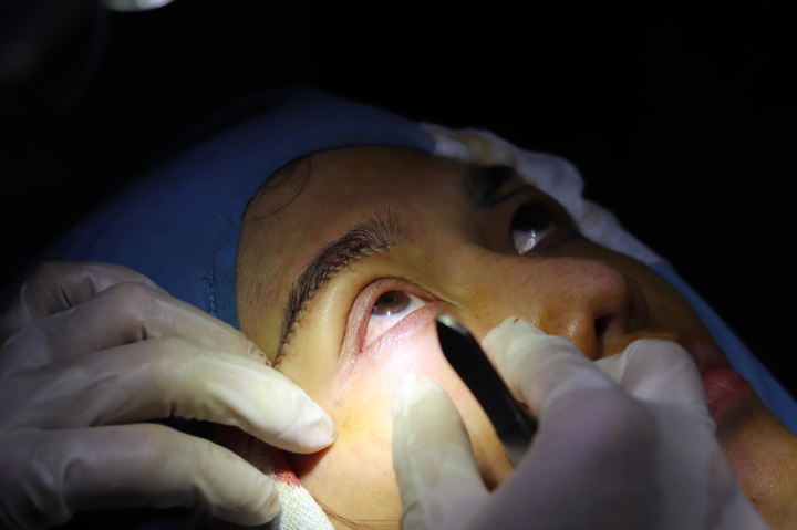 Bác Sĩ Long chỉnh hình mắt 3 mí bằng công nghệ hiện đại