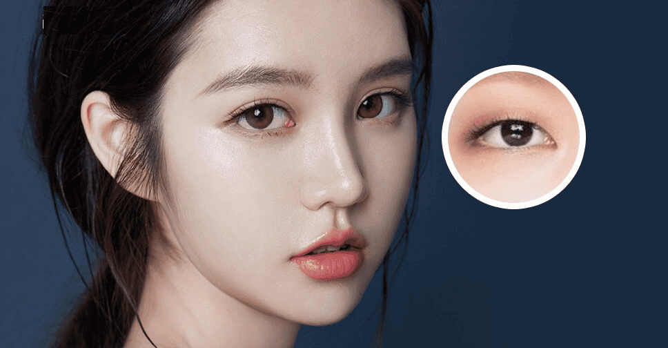 Nhấn Mí Mắt: Tiểu Phẫu Đơn Giản Có Giúp Mắt To Tròn, Tự Nhiên Hay Không? 2 nhan mi mat