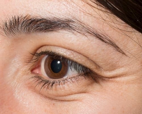 cắt bọng mắt trên