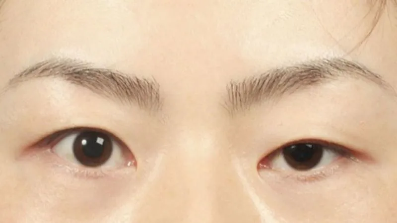 Mắt bên to bên bé là bị gì? 5 nguyên nhân và giải pháp khắc phục hiệu quả