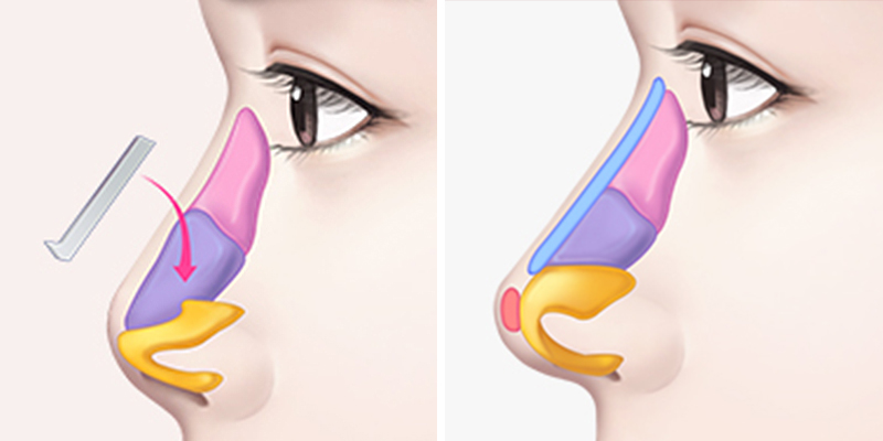 Nâng mũi bán cấu trúc là gì? Giải pháp tạo hình dáng mũi thanh tú tự nhiên nhất