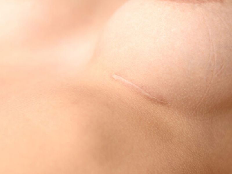 nâng ngực có sẹo không