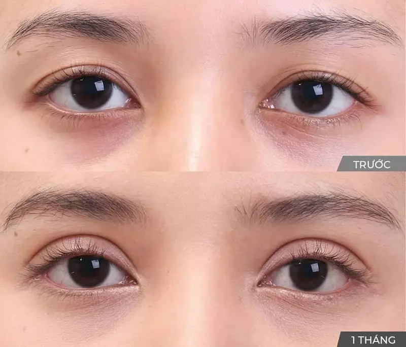 Nhấn mí mắt bao lâu thì tự nhiên? Lộ trình hồi phục chuẩn giúp đôi mắt rạng rỡ