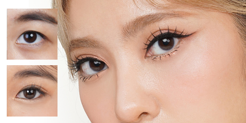 Cắt mí sau bao lâu cắt chỉ? Mốc thời gian vàng để sở hữu đôi mắt đẹp