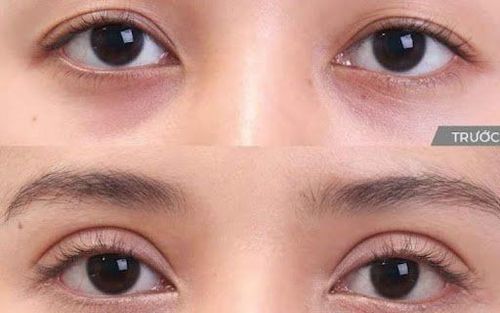 Nhấn mí có làm mắt to hơn không?