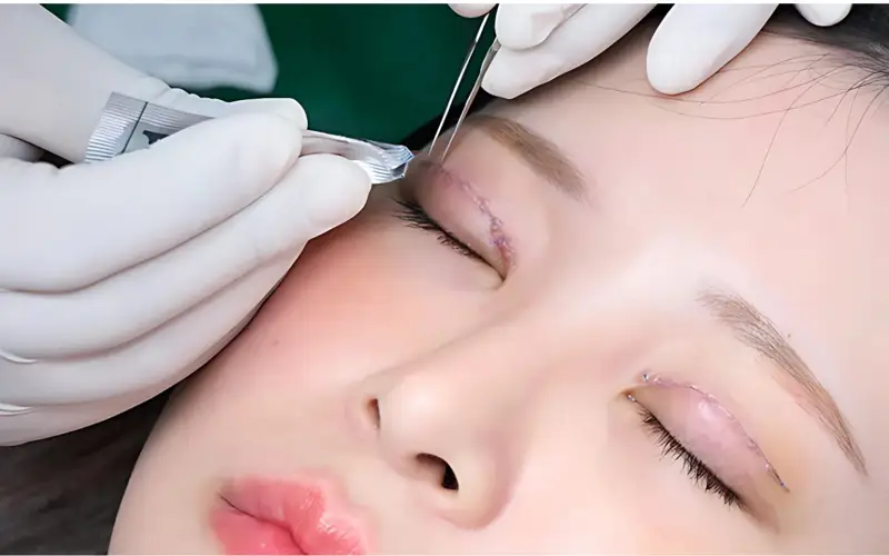 Nhấn mí có cắt chỉ không? Giải đáp từ chuyên gia