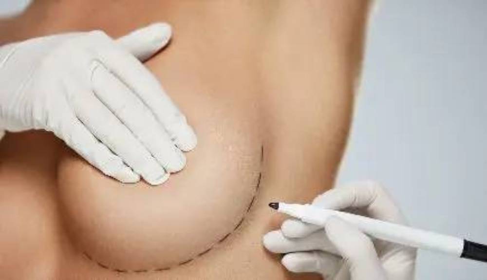 Nâng ngực nội soi đường nách có để lại sẹo lộ liễu không?