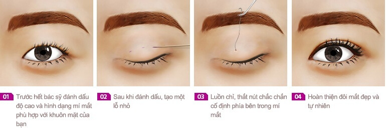 Quy trình bấm mí mắt